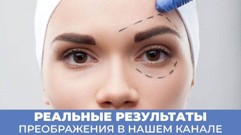 Блефаропластика в Подольске | Soleil Clinic